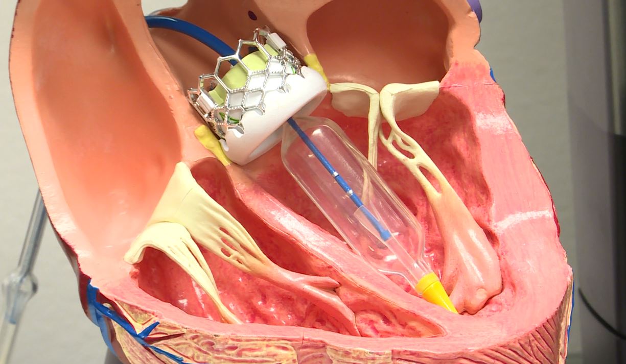 What Is Aortic Valve Replacement Surgery