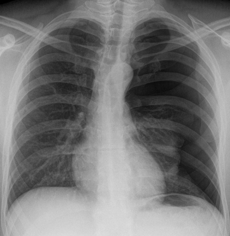 How an AI-based chest X-ray solution detects collapsed lungs