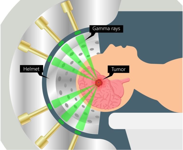 Four Major Advances Made In External Radiotherapy For Treating Cancer